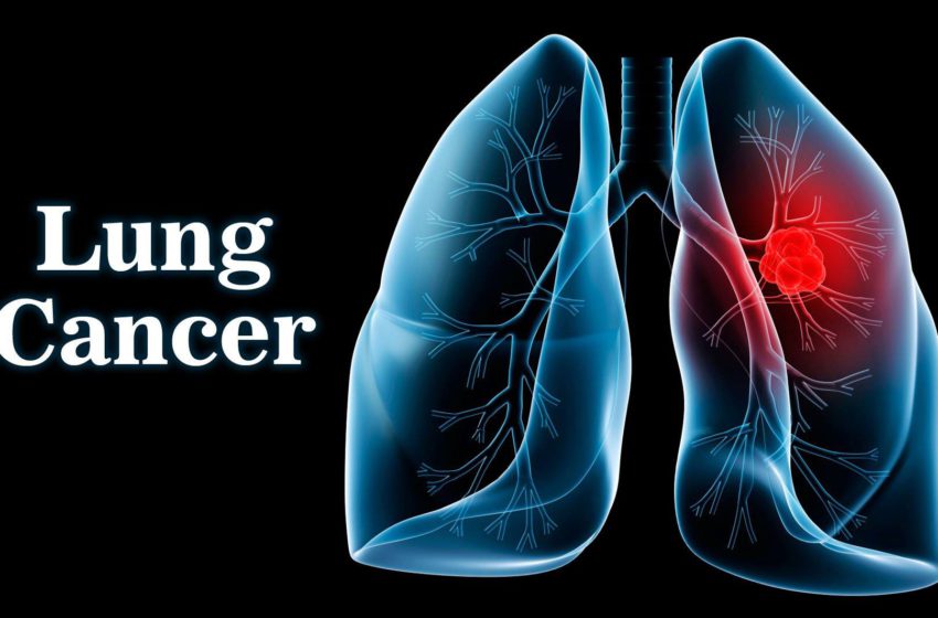  Treatment of lung cancer